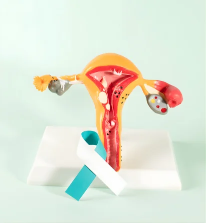 ovarian cysts and-fibroids